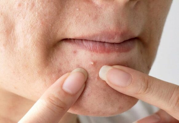 trị mụn dứt điểm là vấn đề nan giải của nhiều người