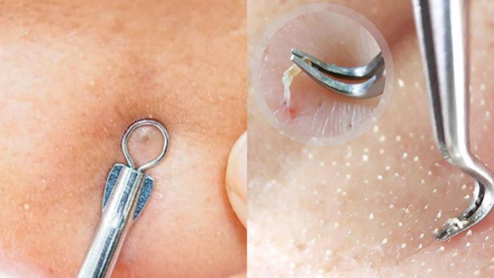 dụng cụ nặn mụn được tin dùng