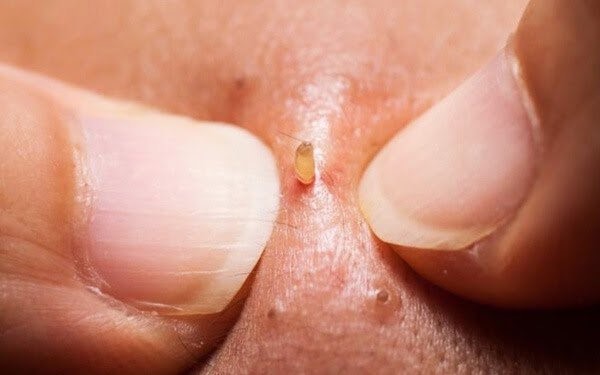 Tự nặn mụn tại nhà có thể gây ra viêm nhiễm, sưng tấy