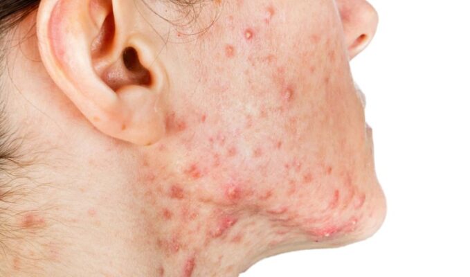 mụn viêm là tình trạng nhiều chị em gặp phải
