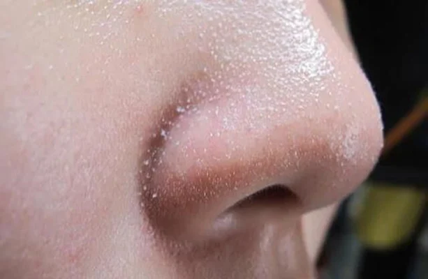 sợi bã nhờn xuất hiện ở cánh mũi
