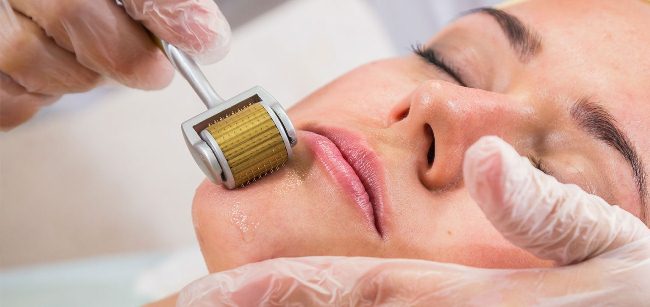 lăn kim điều trị sẹo đáy nhọn