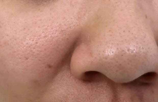 lỗ chân lông to là vấn đề phổ biến của da dầu