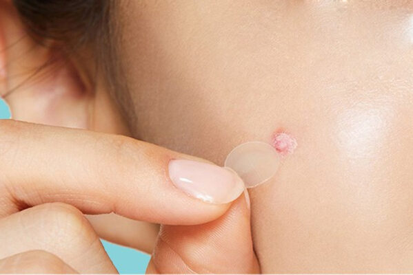 miếng dán mụn là gì