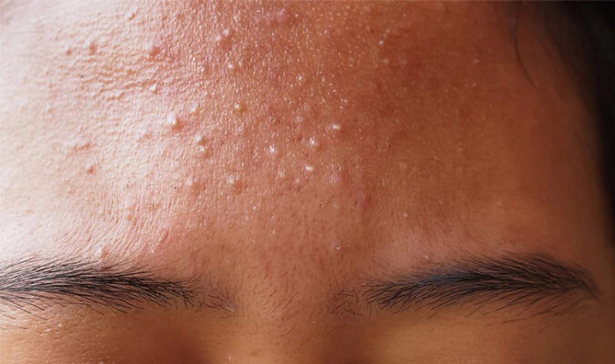 mụn li ti trên trán gây mất thẩm mỹ