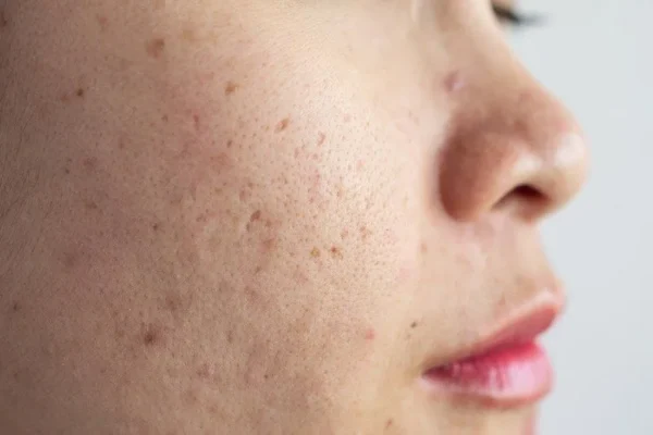 da dầu thường bị mụn ẩn