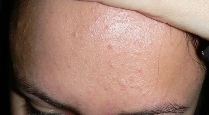 da mặt sần sùi là biểu hiện của da yếu