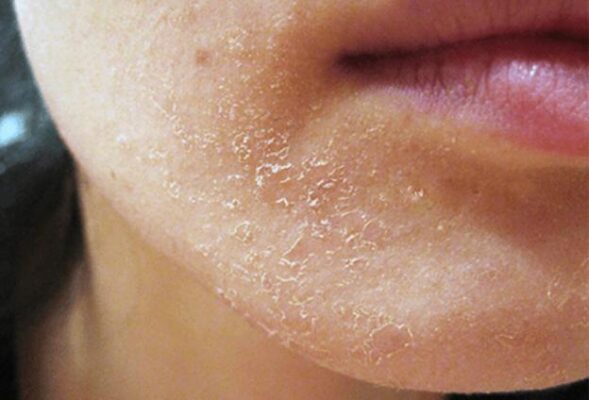 da khô bong tróc khi dùng retinol