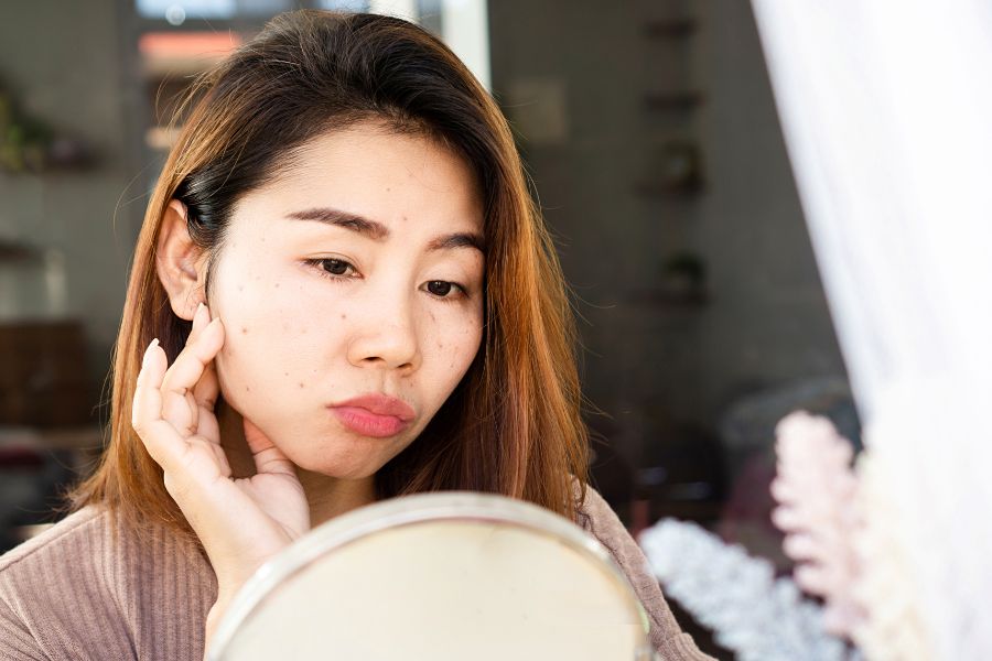 sẹo đáy nhọn hình thành do nặn mụn không đúng cách