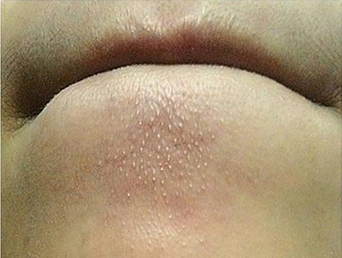 sợi bã nhờn ở cằm gây mất thẩm mỹ