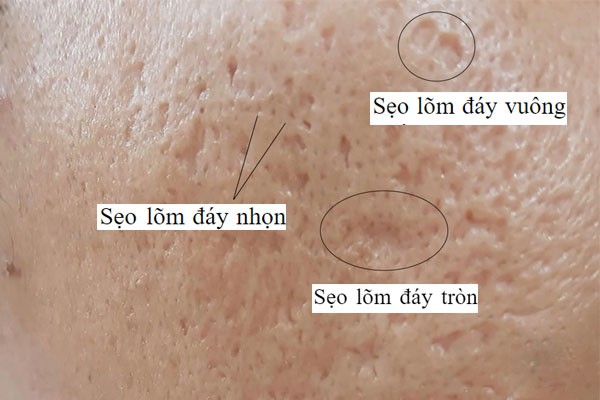 sẹo đáy nhọn làm mất thẩm mỹ cho gương mặt