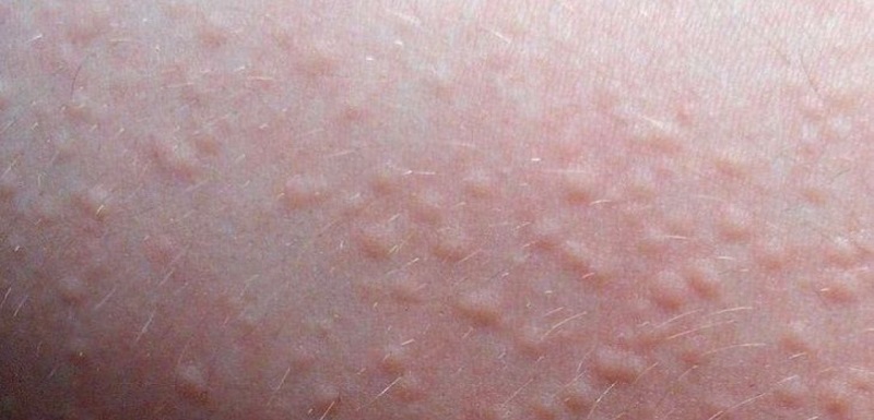 viêm da mẩn ngứa viêm da cơ địa