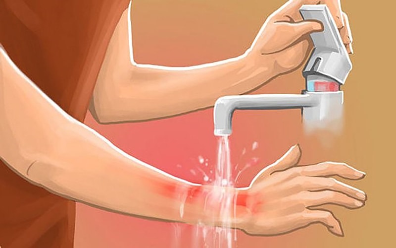 Kem phục hồi bỏng dát da