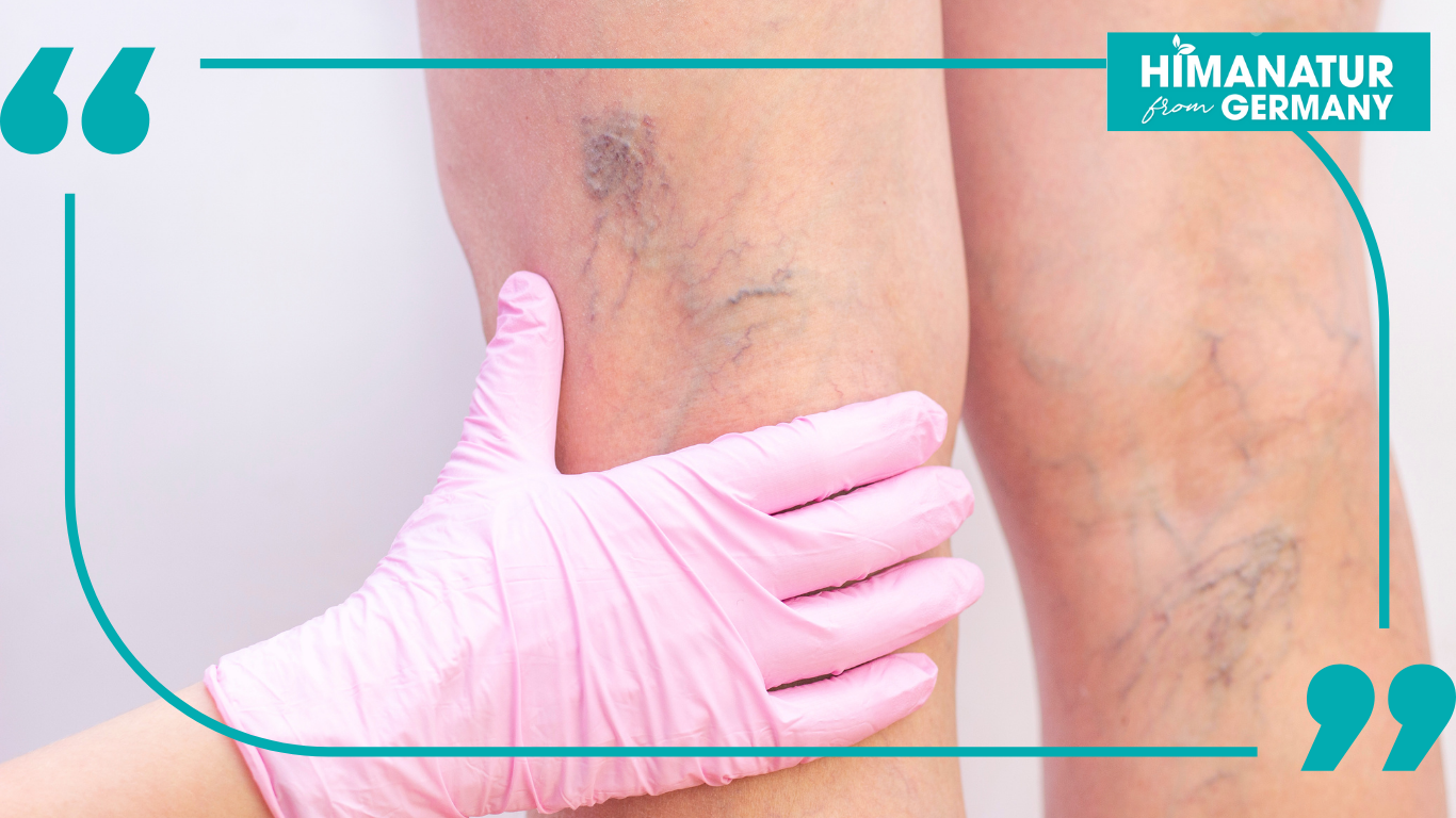 Giãn tĩnh mạch ở người già 