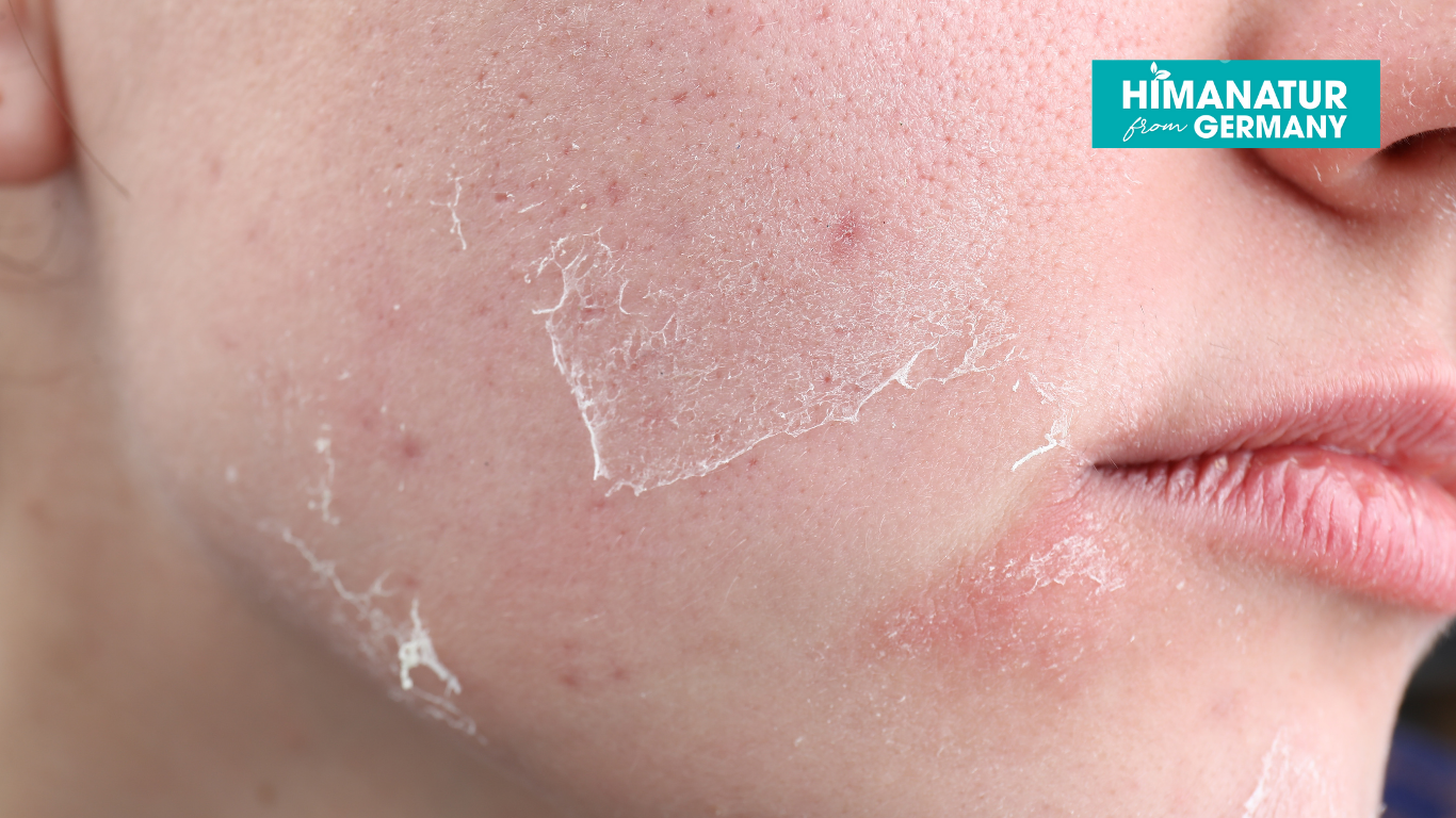 Hình ảnh làn da bong tróc nhẹ sau khi dùng mỹ phẩm kích ứng